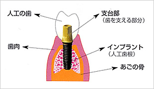 インプラントの説明図