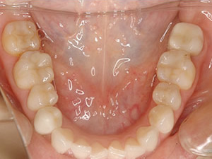 下顎 被せもの施術後